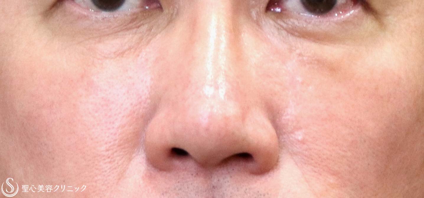 症例写真 術後 プレミアムPRP皮膚再生療法（目の下のくま）