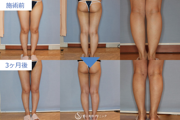 脂肪吸引 下半身全体 の症例写真 聖心美容クリニック福岡院