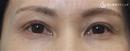 症例写真 術後 プレミアムPRP皮膚再生療法