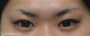 症例写真 術後 二重術（切開法）