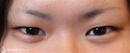 症例写真 術前 二重術（切開法）