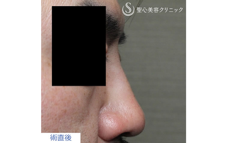 症例写真 注入直後 鼻の整形