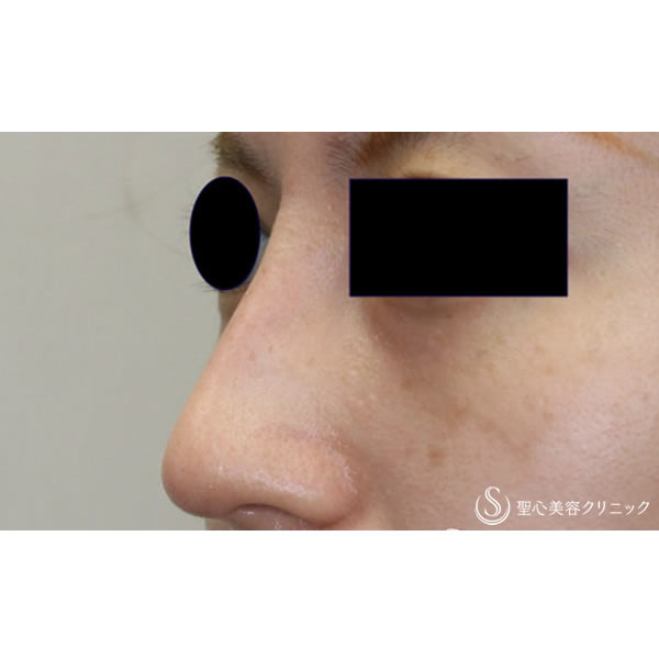 症例写真 術後 鼻の整形