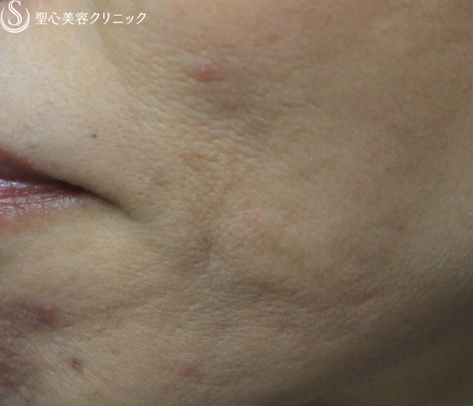美容皮膚科 ホクロ の症例写真 聖心美容クリニック福岡院 美容皮膚科 ホクロ の症例写真 聖心美容クリニック福岡院