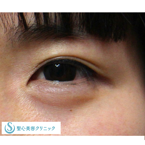 症例写真 術後 目のくま・くぼみ・たるみ・眼瞼下垂