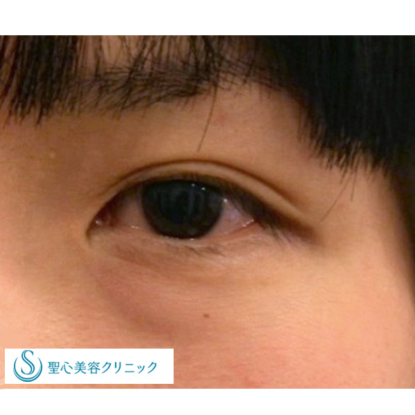 症例写真 術前 目のくま・くぼみ・たるみ・眼瞼下垂
