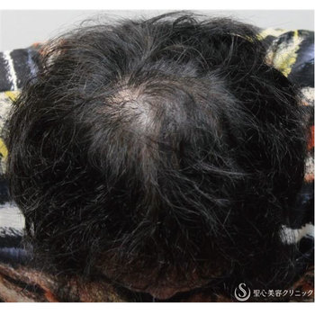 症例写真 術後 毛髪再生療法 プレミアムグロースファクター再生療法