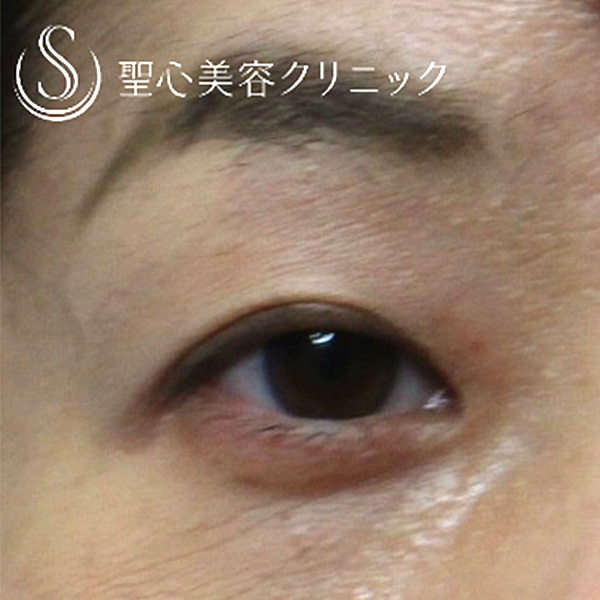 症例写真 術後 目のくま・くぼみ・たるみ・眼瞼下垂