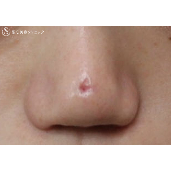 症例写真 術前 鼻の整形