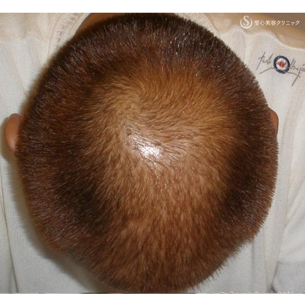 症例写真 術後 毛髪再生療法 グロースファクター再生療法