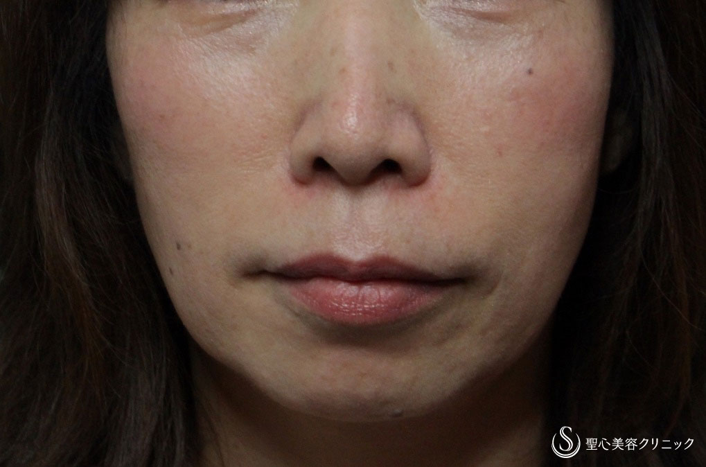 症例写真 術後 プレミアムPRP皮膚再生療法