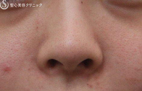 症例写真 術前 鼻尖形成（耳介軟骨移植）
