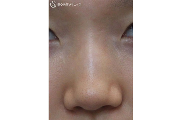 症例写真 術前 鼻のプロテーゼ