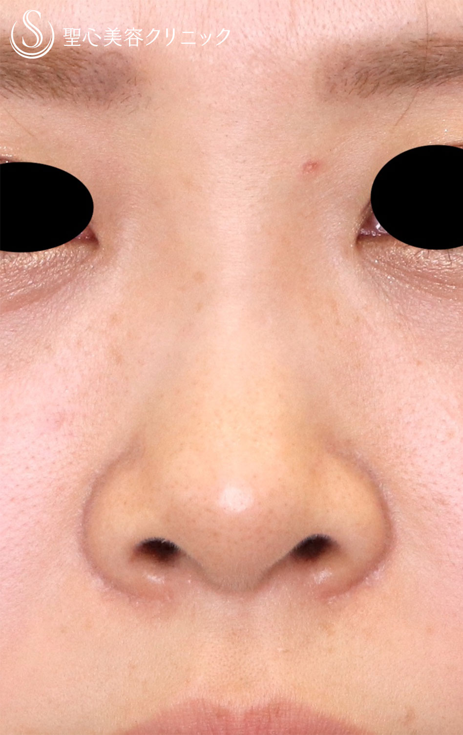 3Dオーダーメイドプロテーゼ隆鼻術+鼻尖形成（耳介軟骨移植））_Before
