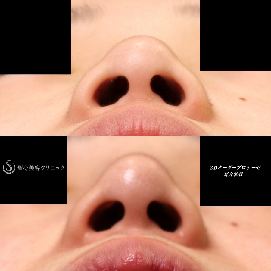 3Dオーダーメイドプロテーゼ隆鼻術＋鼻尖形成（耳介軟骨移植）_After