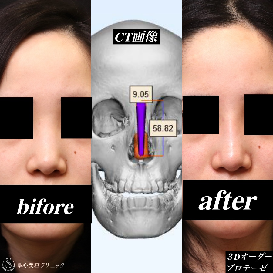 3Dオーダーメイドプロテーゼ隆鼻術＋鼻尖形成（耳介軟骨移植）_Before