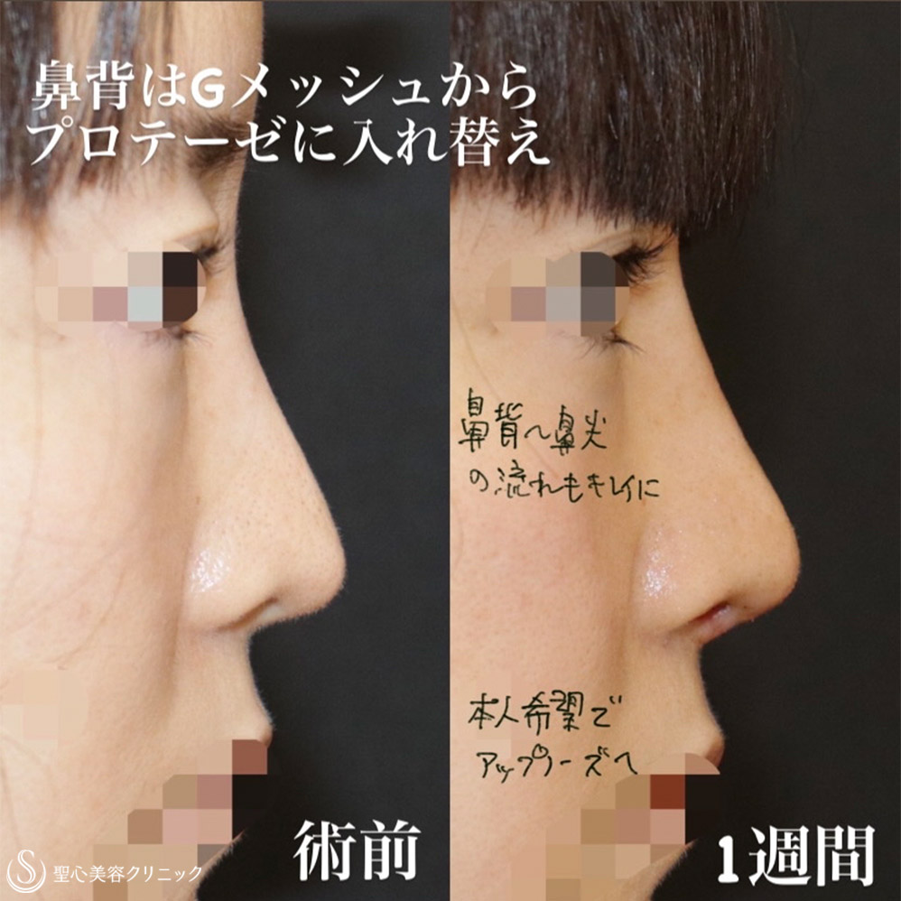 鼻尖縮小+ 鼻尖形成（耳介軟骨移植）+ プロテーゼによる隆鼻術+ 移植軟骨除去__After