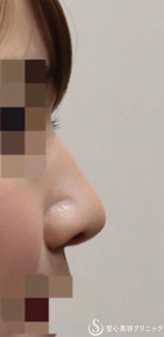 オステオポール抜去＋変形した鼻尖の再建＋耳介軟骨移植による鼻尖形成_After