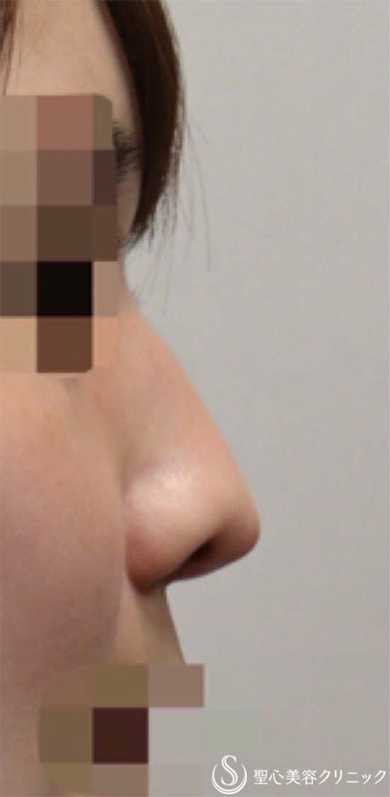 オステオポール抜去＋変形した鼻尖の再建＋耳介軟骨移植による鼻尖形成_Before