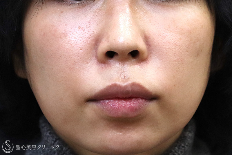 目の下の脂肪取り（経結膜下脱脂法）＋プレミアムPRP皮膚再生療法_After