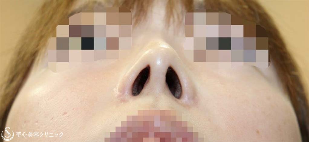鼻中隔延長術＋鼻尖形成（耳介軟骨移植）＋鼻孔縁下降術＋他院修正_Before