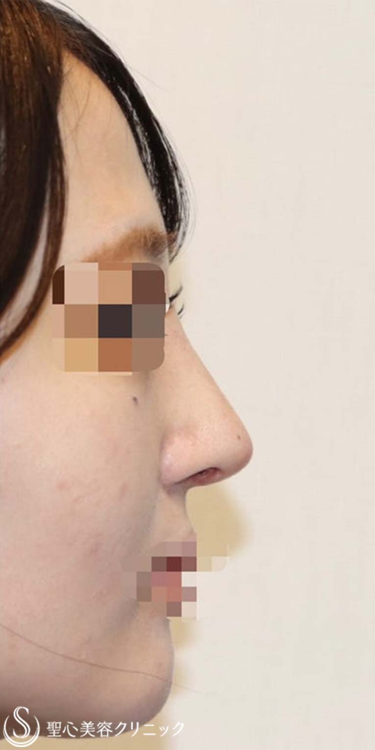 鼻中隔延長術＋鼻尖形成（耳介軟骨移植）＋プロテーゼによる隆鼻術_After