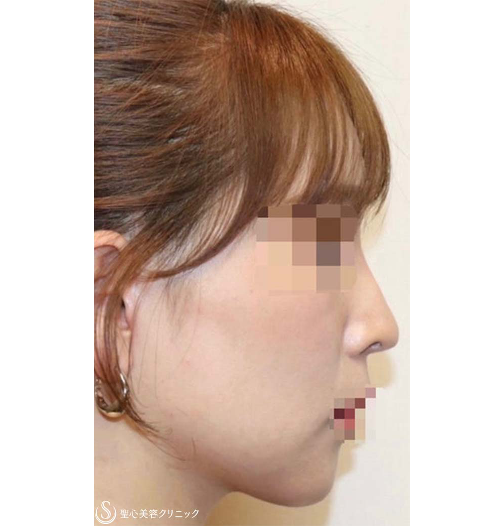 症例写真 術後 フェイスリフト＋頬の脂肪吸引＋リガメント