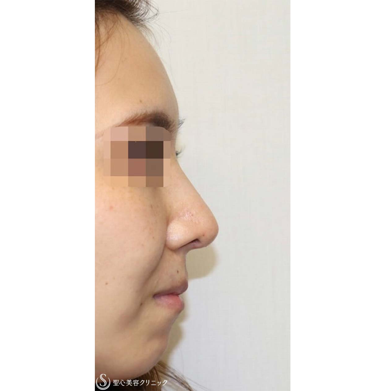 症例写真 術後 鼻中隔延長・鼻尖形成術・鼻背軟骨移植