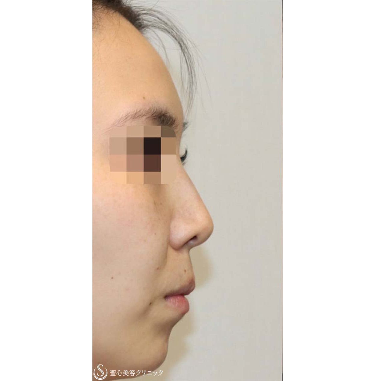 症例写真 術前 鼻中隔延長・鼻尖形成術・鼻背軟骨移植