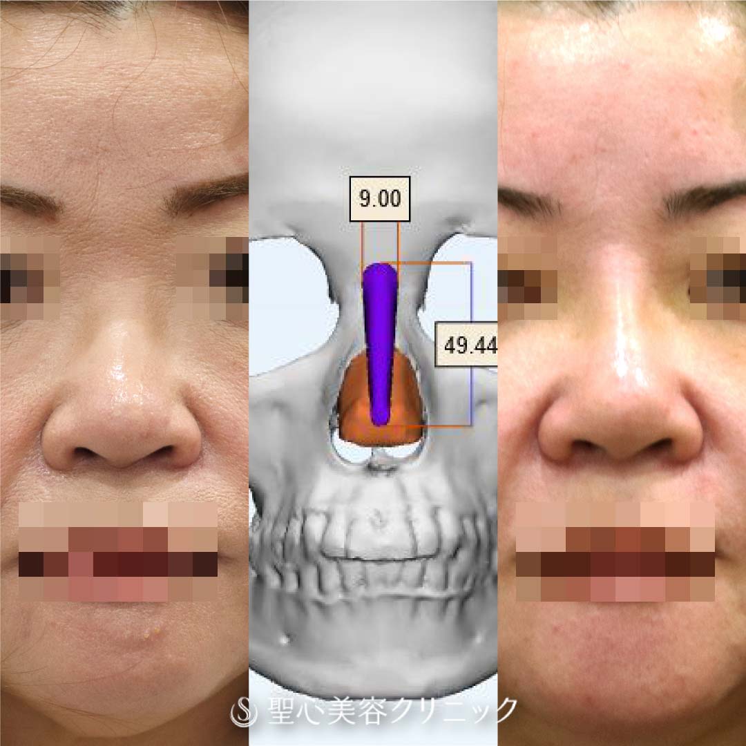 3Dオーダーメイドプロテーゼ隆鼻術＋鼻尖形成（耳介軟骨移植）_Before