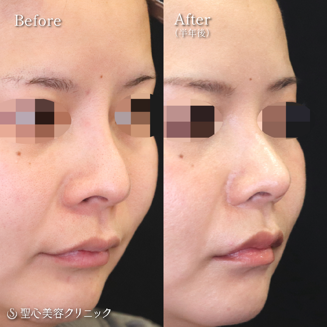 鼻尖縮小＋鼻尖形成（耳介軟骨移植）＋プロテーゼ取り出し・プロテーゼ入替＋小鼻縮小＋オステオポール除去_After