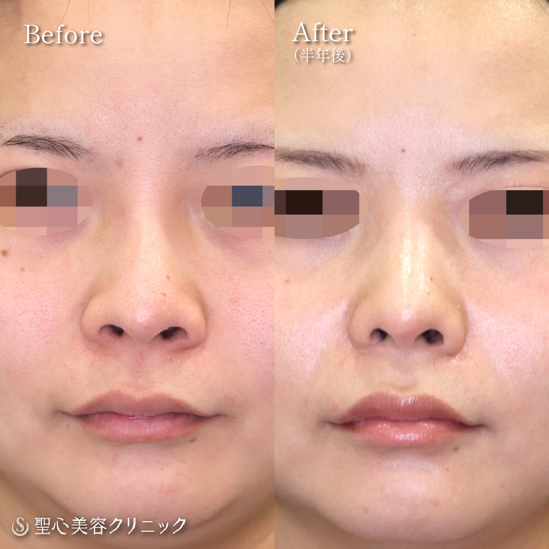 鼻尖縮小＋鼻尖形成（耳介軟骨移植）＋プロテーゼ取り出し・プロテーゼ入替＋小鼻縮小＋オステオポール除去_Before