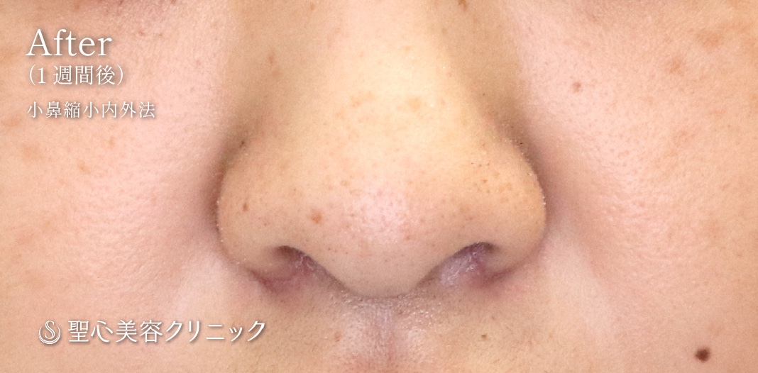 小鼻縮小_After
