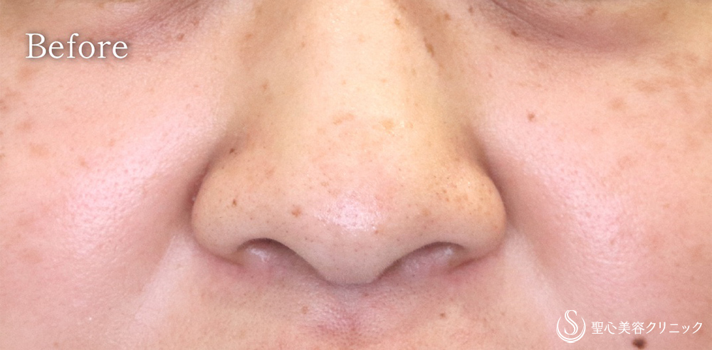 小鼻縮小_Before