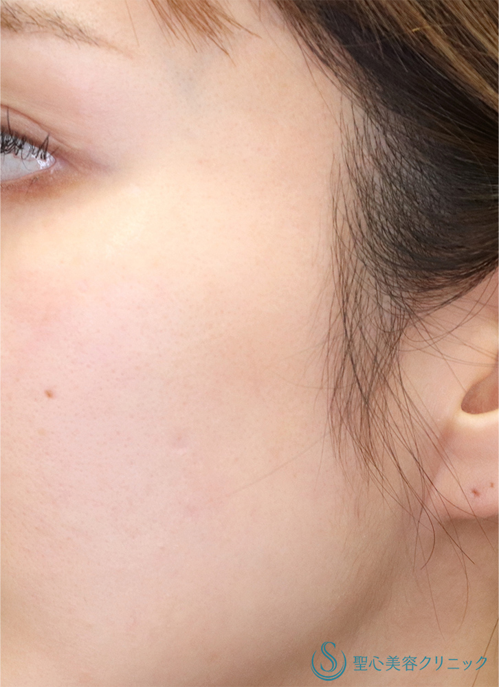 プレミアムPRP皮膚再生療法_After