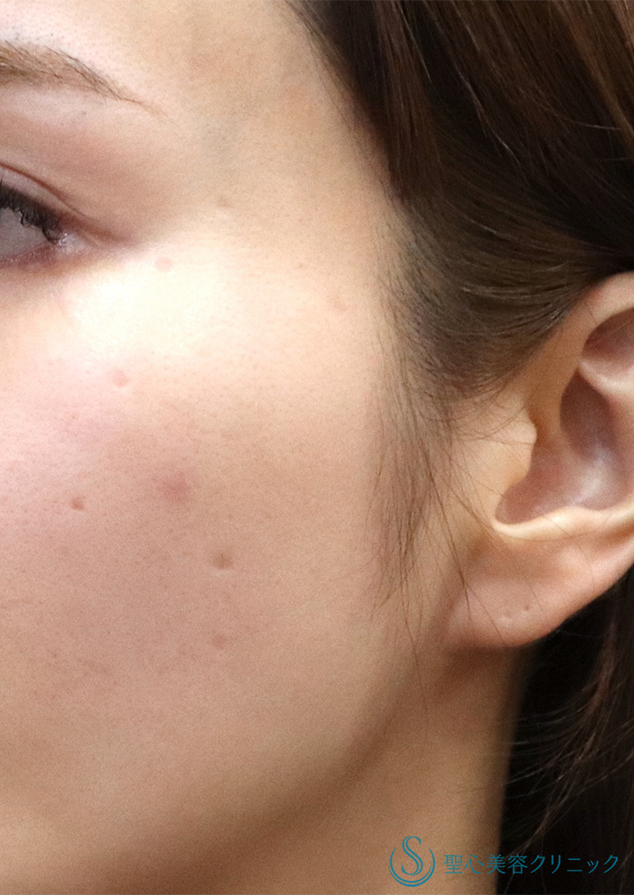 プレミアムPRP皮膚再生療法_Before