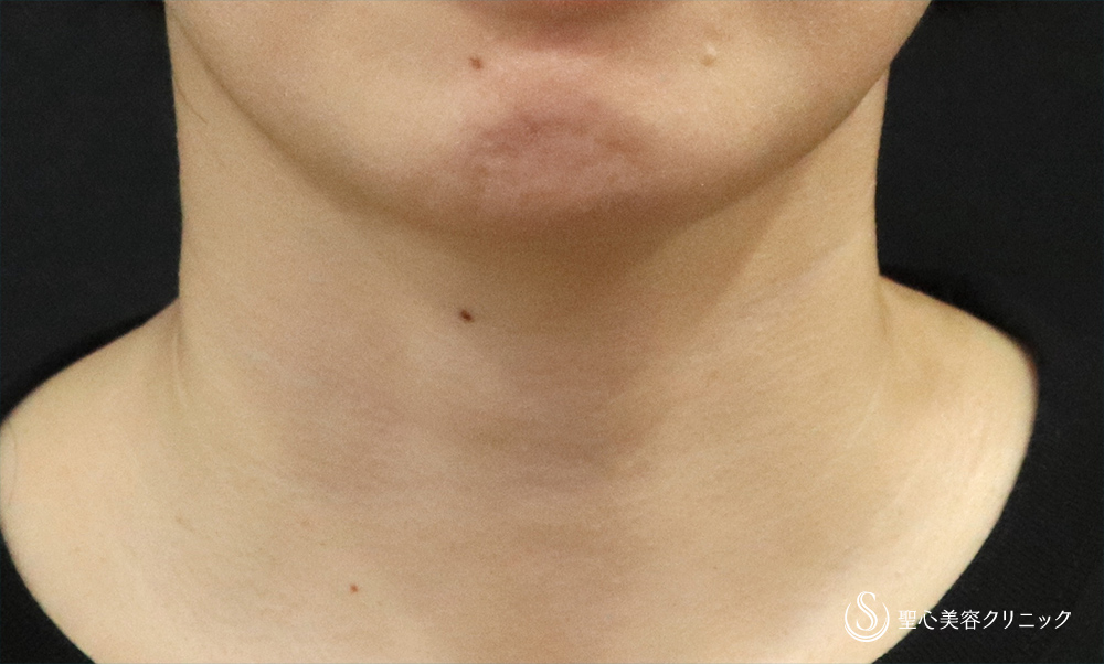 プレミアムPRP皮膚再生療法_After