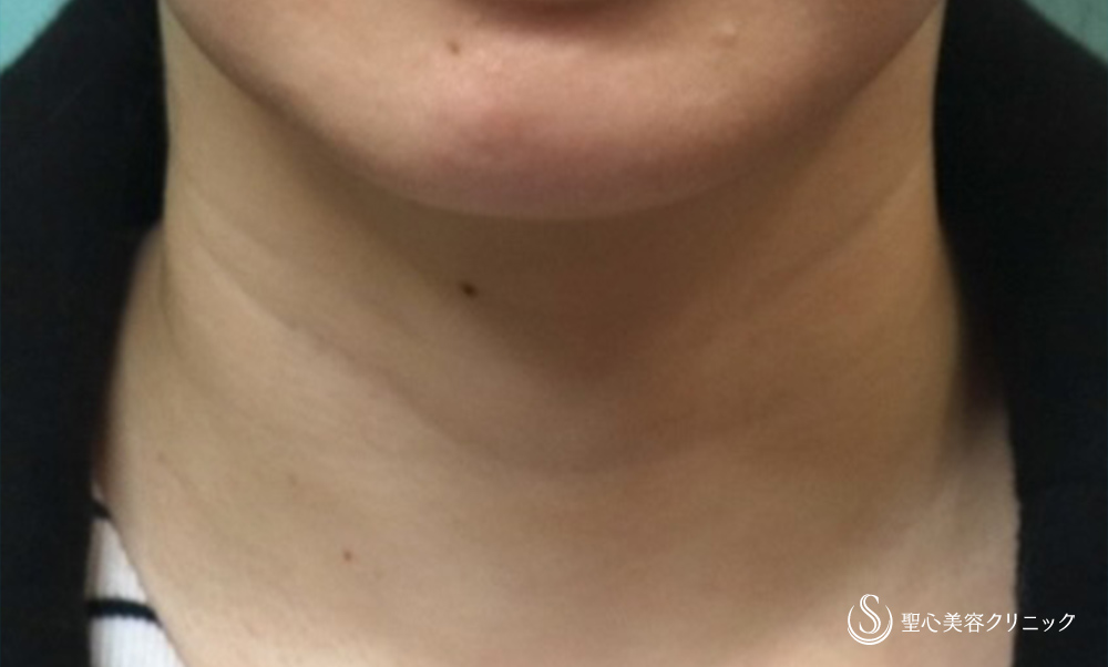 プレミアムPRP皮膚再生療法_Before