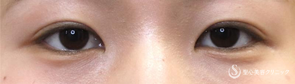 目頭切開/目上切開_Before