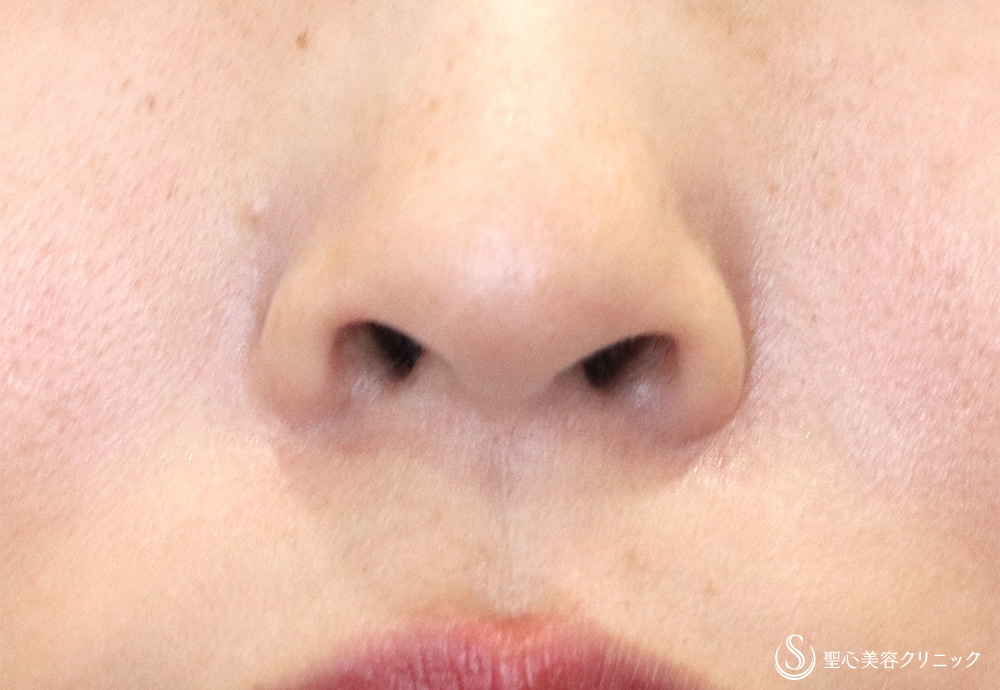 鼻孔縁下降術_After