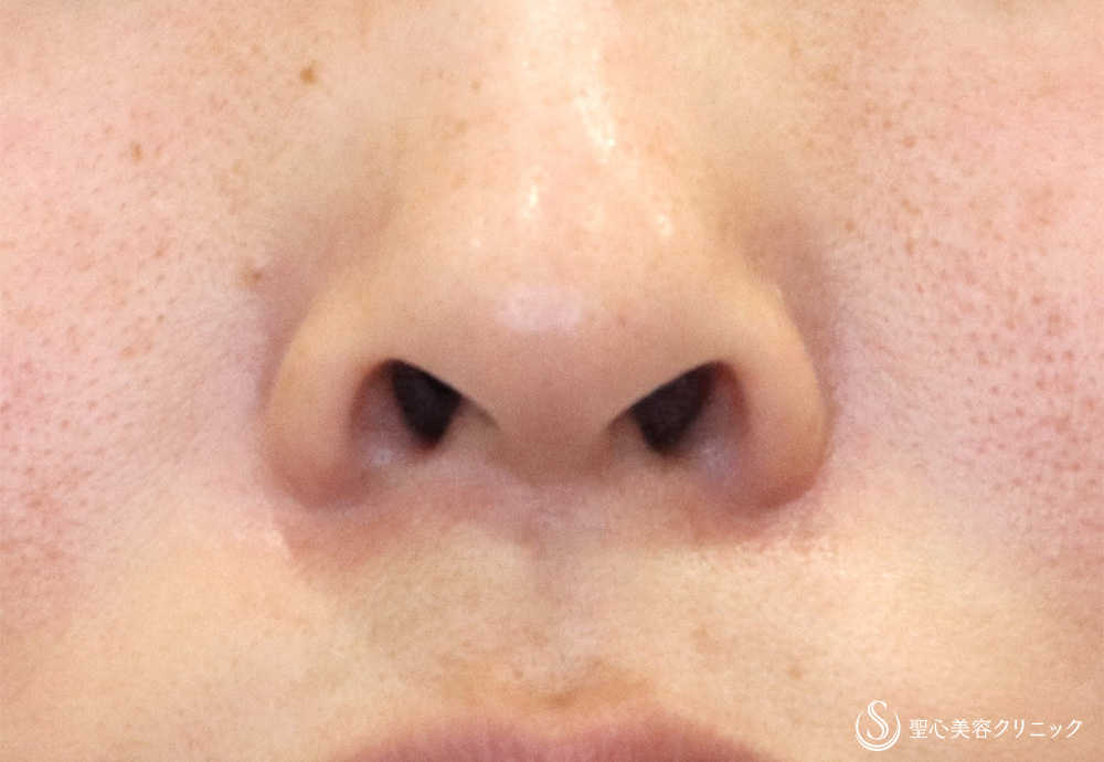 鼻孔縁下降術_Before