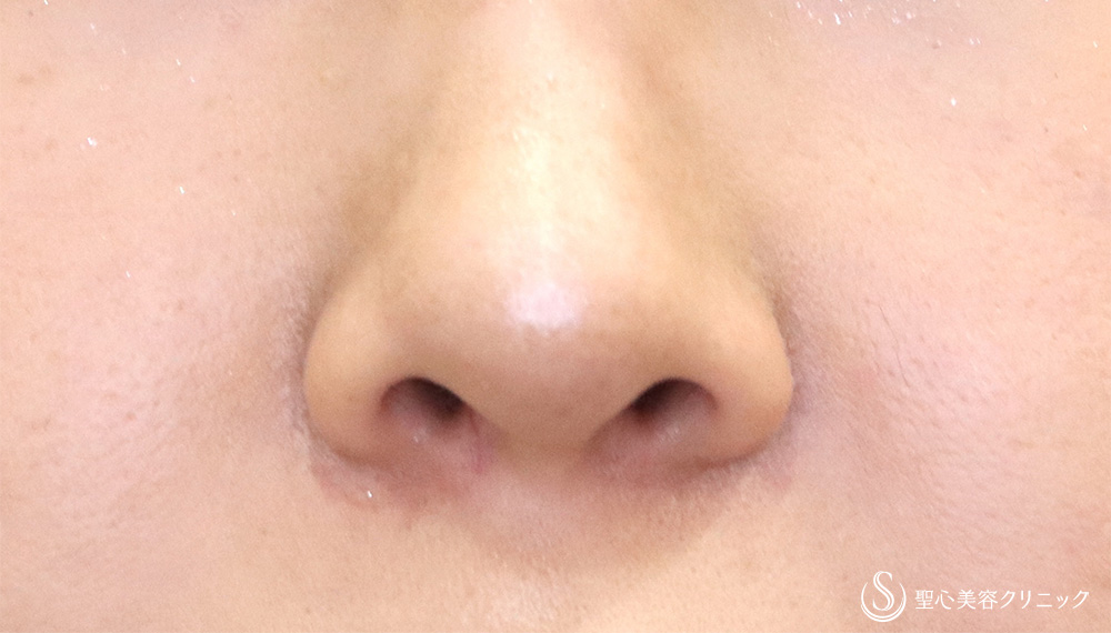 鼻孔縁下降術_After