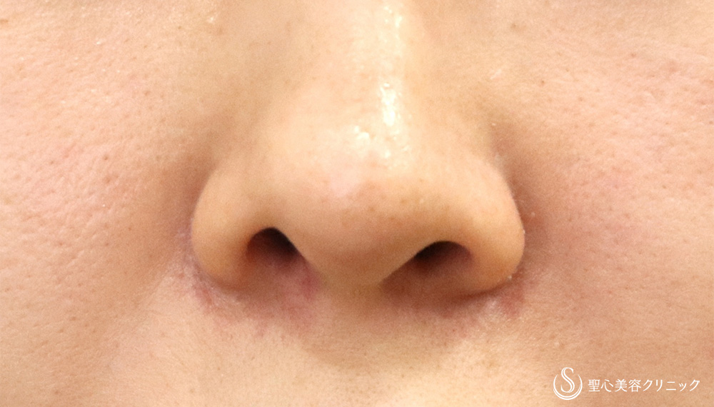 鼻孔縁下降術_Before