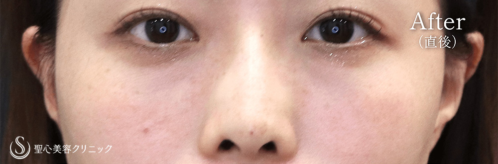 ヒアルロン酸注入（鼻）_After