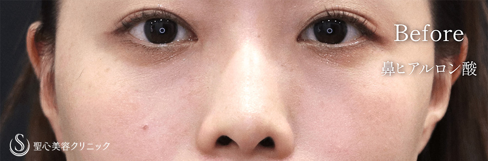 ヒアルロン酸注入（鼻）_Before