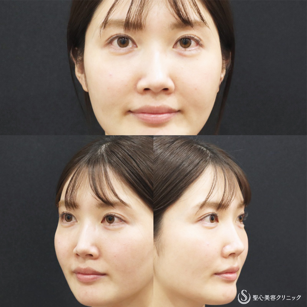 ヒアルロン酸注入（涙袋）_After