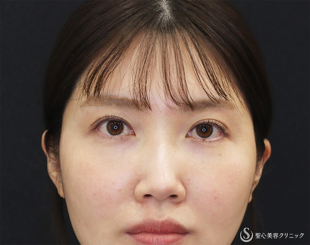 ヒアルロン酸注入（涙袋）_Before