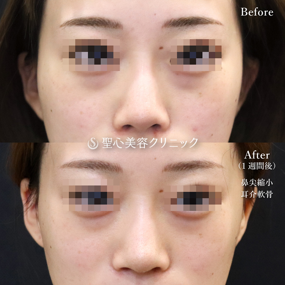 鼻尖縮小＋鼻尖形成（耳介軟骨移植）_After