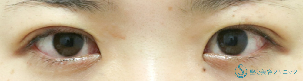 二重術（埋没法）：マイクロメソッド+α_After