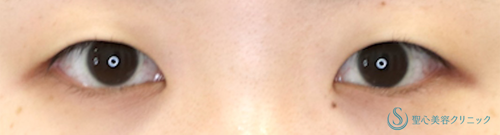 二重術（埋没法）：マイクロメソッド+α_Before